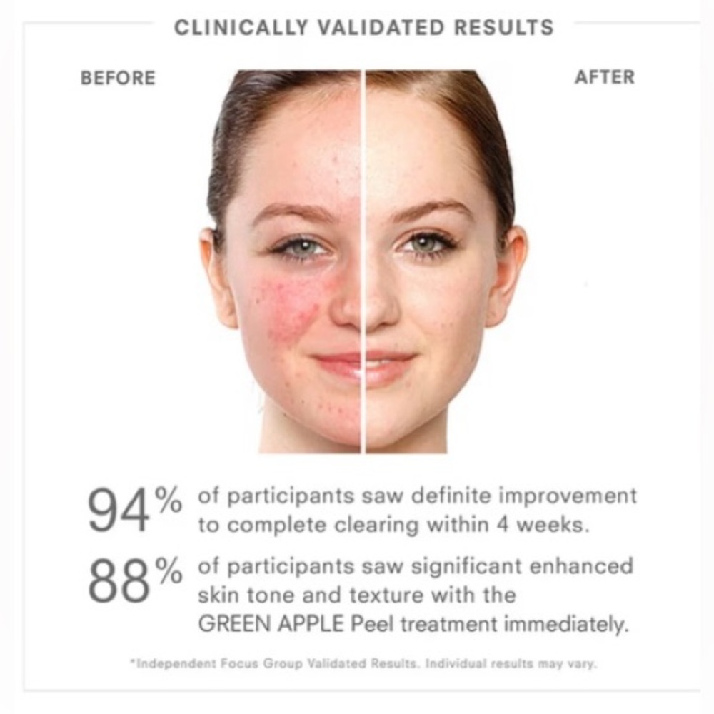 Juice Beauty Blemish & Acne Serum Blemish & Breakout Clearing Skincare Treatment - Picture 2 of 5